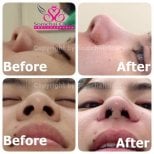 Before and after alarplasty results at Somchai Clinic, visible nostril reshaping improvement