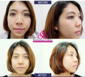 Before and after alarplasty results at Somchai Clinic, nose reshaping with refined nostrils