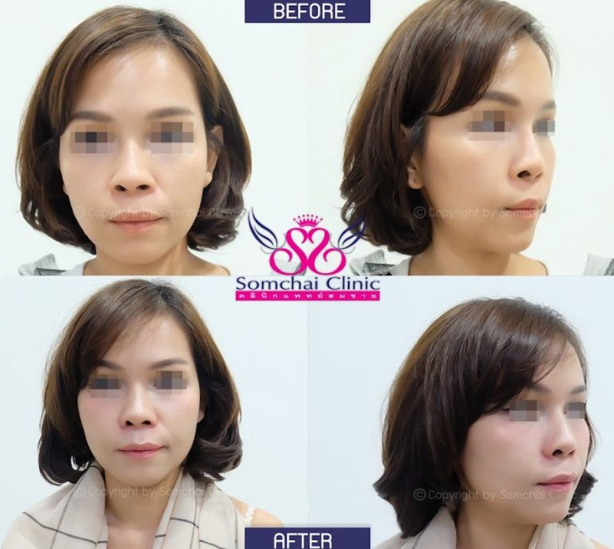 Resultados antes y después de alarplastia en Somchai Clinic, mejora visible de la nariz