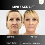 Результаты мини-лифтинга лица до и после в ID Clinic Bangkok, видимое омоложение лица