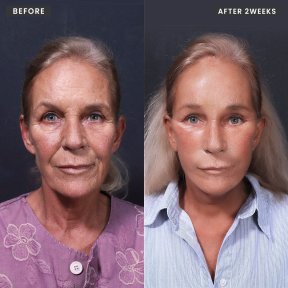 Facelift Vorher-Nachher-Ergebnisse bei VG Plastic Surgery, sichtbare Verjüngung nach 2 Wochen