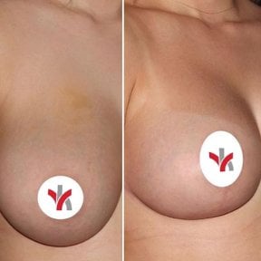 Vorher-nachher-Ergebnis Brustimplantate mit Straffung bei Private Yüzyıl Hospital, verbesserte Form