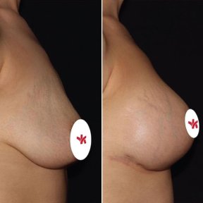 Vorher-nachher-Ergebnis Brustimplantate mit Straffung bei Private Yüzyıl Hospital, verbesserte Form