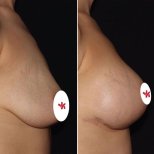 Vorher-nachher-Ergebnis Brustimplantate mit Straffung bei Private Yüzyıl Hospital, verbesserte Form