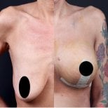 Vorher-nachher Brustimplantate mit Straffung bei Private Yüzyıl Hospital, verbesserte Form