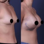 Vorher-nachher-Ergebnis Brustimplantate mit Straffung bei Private Yüzyıl Hospital, verbesserte Form