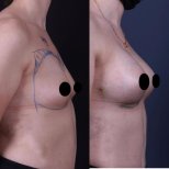 Vorher-nachher-Ergebnis Brustimplantate mit Straffung bei Private Yüzyıl Hospital, Kontur verbessert