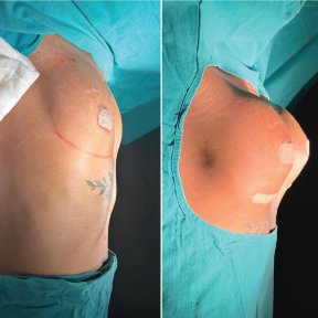 Vorher-nachher Brustimplantate mit Straffung bei Private Yüzyıl Hospital, verbesserte Form