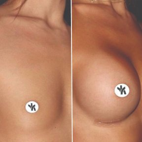 Vorher-nachher-Ergebnis Brustimplantate mit Straffung bei Private Yüzyıl Hospital, vollere Brust