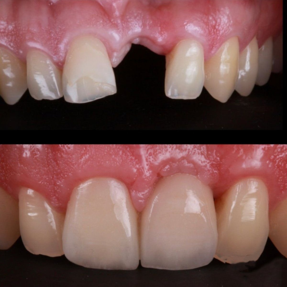نتائج قبل وبعد تركيب تيجان البورسلين في RO Dental Clinic – ترميم الأسنان الأمامية