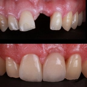 Before and after porcelain crown installation at RO Dental Clinic – restored front teeth result