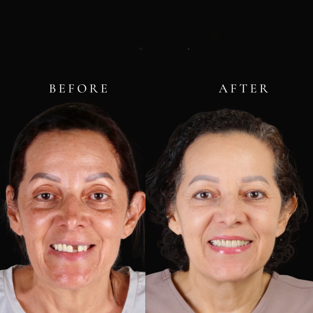 قبل وبعد تركيب تيجان البورسلين في RO Dental Clinic، نتيجة استعادة الابتسامة