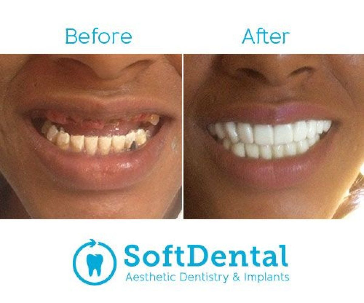 Resultados antes y después de implantes All-on-4 en SoftDentalCare Clinic, restauración de sonrisa