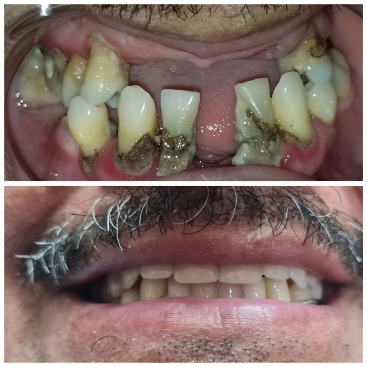 Resultados antes y después de implantes All-on-4 en SoftDentalCare Clinic, sonrisa restaurada