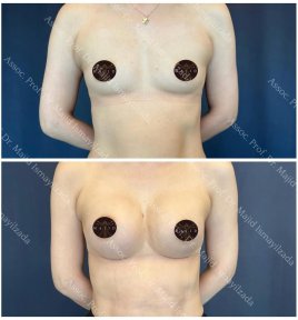 Vorher-nachher-Ergebnisse Brustvergrößerung bei Liv Hospital Vadistanbul, verbesserte Form