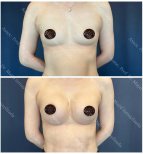 Vorher-nachher-Ergebnisse Brustvergrößerung bei Liv Hospital Vadistanbul, verbesserte Form