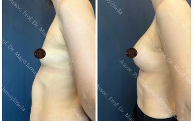 Vorher-nachher Brustvergrößerung in Liv Hospital Vadistanbul, sichtbares Volumenergebnis