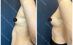 Vorher-nachher Brustvergrößerung in Liv Hospital Vadistanbul, sichtbares Volumenergebnis