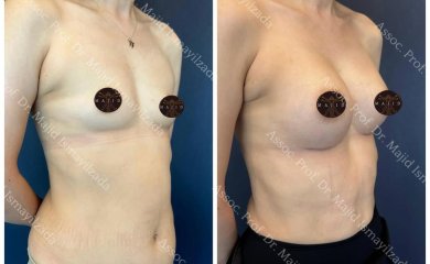 Vorher-nachher-Ergebnis Brustvergrößerung bei Liv Hospital Vadistanbul, mehr Brustvolumen