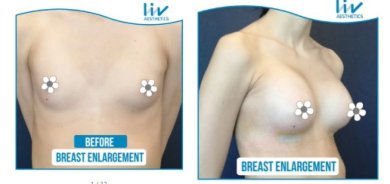 Vorher-nachher-Ergebnis Brustvergrößerung bei Liv Hospital Vadistanbul, größere Brust