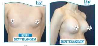 Vorher-nachher-Ergebnis Brustvergrößerung bei Liv Hospital Vadistanbul, größere Brust