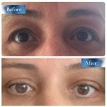 Результаты до и после операции двойного века в клинике Prof. Dr. Ahmet Satici