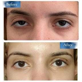 Результаты до и после операции на двойное веко в клинике Prof. Dr. Ahmet Satici