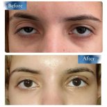 Результаты до и после операции на двойное веко в клинике Prof. Dr. Ahmet Satici