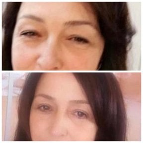 نتائج رأب الجفن قبل وبعد في عيادة البروفيسور د. أحمد ساتيجي الخاصة