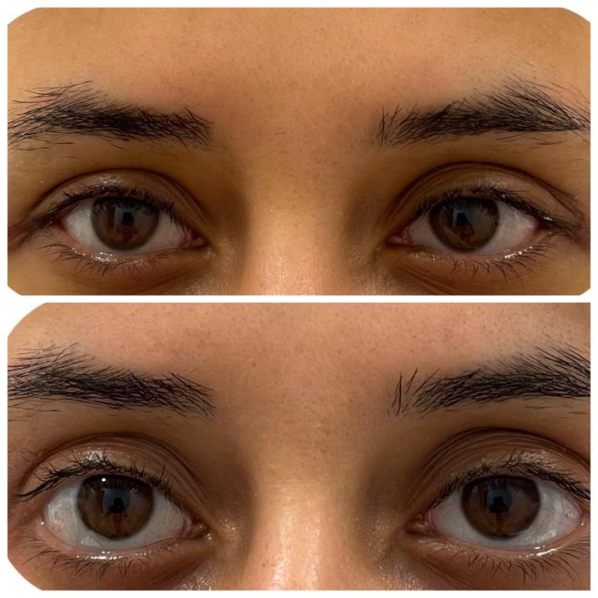 Resultados antes y después de cirugía de párpados caídos en Prof. Dr. Ahmet Satici