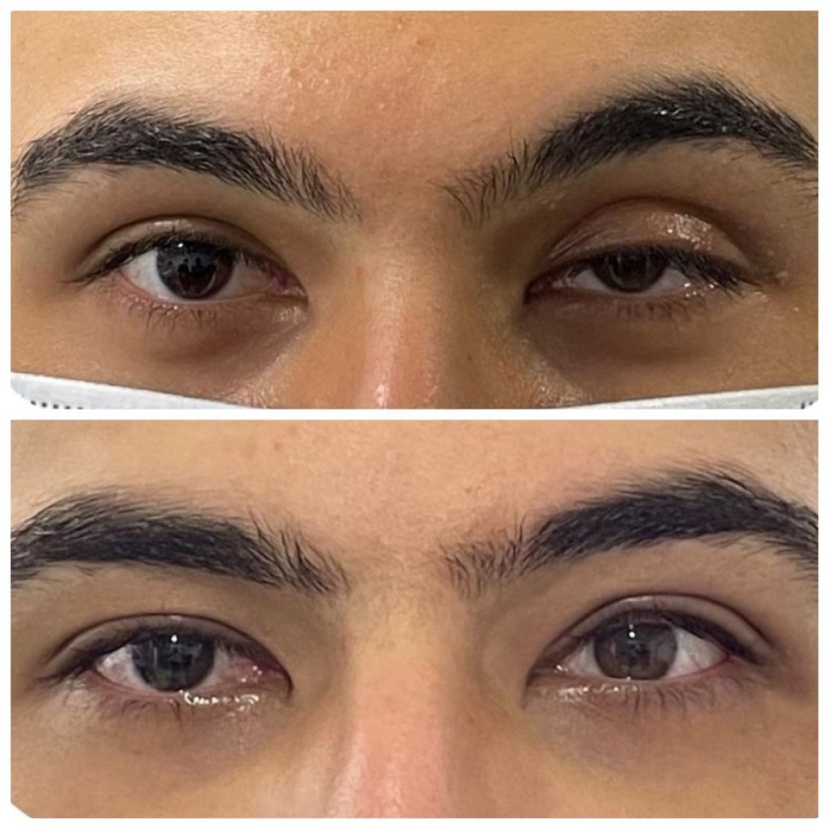 Resultados antes y después de cirugía de párpado caído en la clínica Prof. Dr. Ahmet Satici