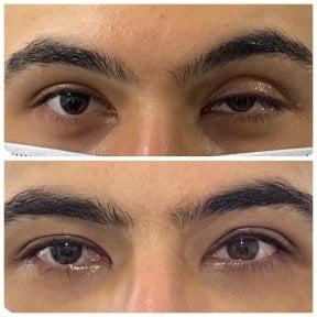 Before and after droopy eyelid surgery results at Prof. Dr. Ahmet Satici's Private Practice