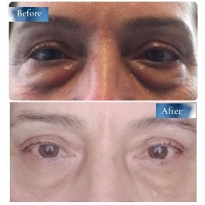 نتائج رأب الجفن قبل وبعد في عيادة البروفيسور د. أحمد ساتيجي، تصحيح الجفون