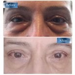 نتائج رأب الجفن قبل وبعد في عيادة البروفيسور د. أحمد ساتيجي، تصحيح الجفون