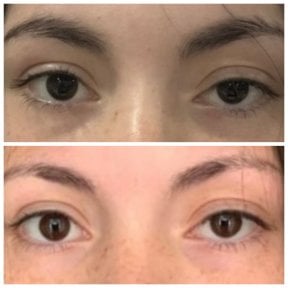 Before and after droopy eyelid surgery results at Prof. Dr. Ahmet Satici's Private Practice