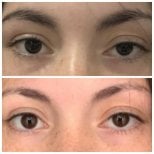 Before and after droopy eyelid surgery results at Prof. Dr. Ahmet Satici's Private Practice