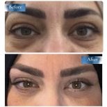Vorher-nachher-Ergebnisse der Blepharoplastik bei Prof. Dr. Ahmet Satici