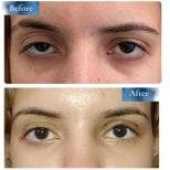 Before and after droopy eyelid surgery results at Prof. Dr. Ahmet Satici's Private Practice