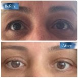 Vorher-nachher-Ergebnisse der Blepharoplastik bei Prof. Dr. Ahmet Satici, Lidkorrektur