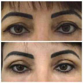 Vorher-nachher-Ergebnis der Blepharoplastik bei Prof. Dr. Ahmet Satici, Lidstraffung