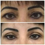 Vorher-nachher-Ergebnis der Blepharoplastik bei Prof. Dr. Ahmet Satici, Lidstraffung