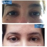 Vorher-nachher-Ergebnisse der Blepharoplastik in Prof. Dr. Ahmet Saticis Privatpraxis