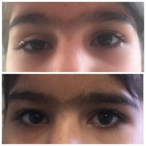 Before and after droopy eyelid surgery results at Prof. Dr. Ahmet Satici's Private Practice