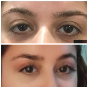 Before and after hooded eyelid surgery results at Prof. Dr. Ahmet Satici's Private Practice