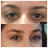 Before and after hooded eyelid surgery results at Prof. Dr. Ahmet Satici's Private Practice