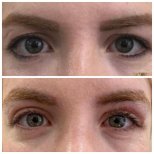 Before and after hooded eyelid surgery results at Prof. Dr. Ahmet Satici's Private Practice