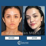 Fox Eye Lift Vorher-Nachher-Ergebnisse bei Dr. Candan Mezili, Lidstraffung