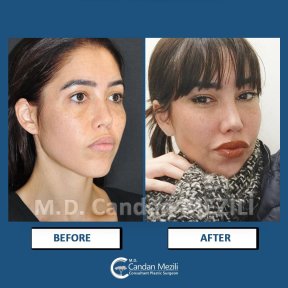 Fox Eye Lift Vorher-Nachher-Ergebnis bei Dr. Candan Mezili, verbesserte Augenform