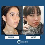 Fox Eye Lift Vorher-Nachher-Ergebnis bei Dr. Candan Mezili, verbesserte Augenform