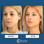 Результати до і після Fox Eye Lift у клініці Dr. Candan Mezili, 2 місяці після операції